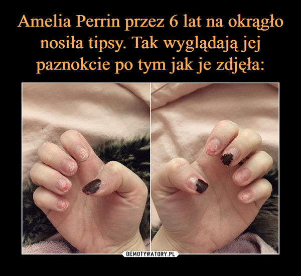 Amelia Perrin przez 6 lat na okrągło nosiła tipsy. Tak wyglądają jej paznokcie po tym jak je zdjęła: