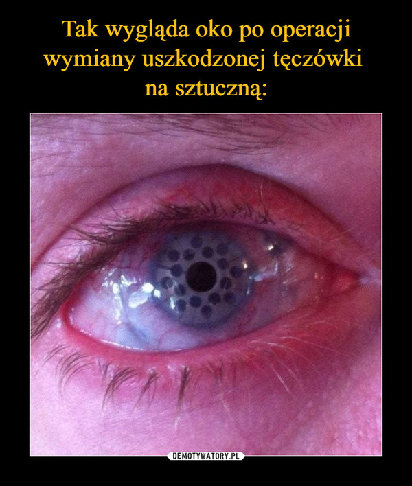 Tak wygląda oko po operacji wymiany uszkodzonej tęczówki 
na sztuczną: