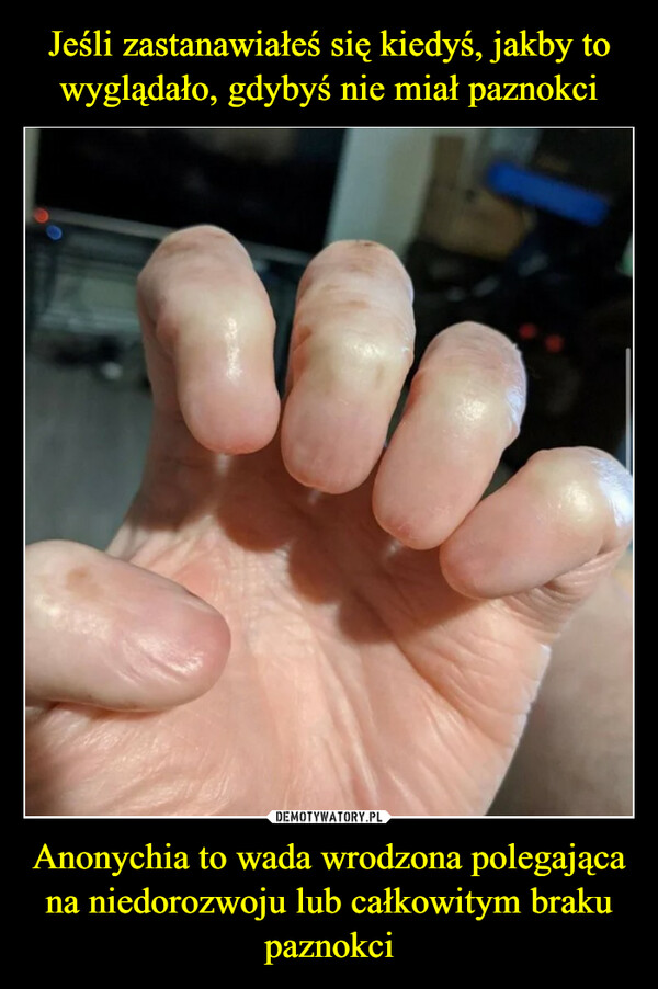 Jeśli zastanawiałeś się kiedyś, jakby to wyglądało, gdybyś nie miał paznokci Anonychia to wada wrodzona polegająca na niedorozwoju lub całkowitym braku paznokci