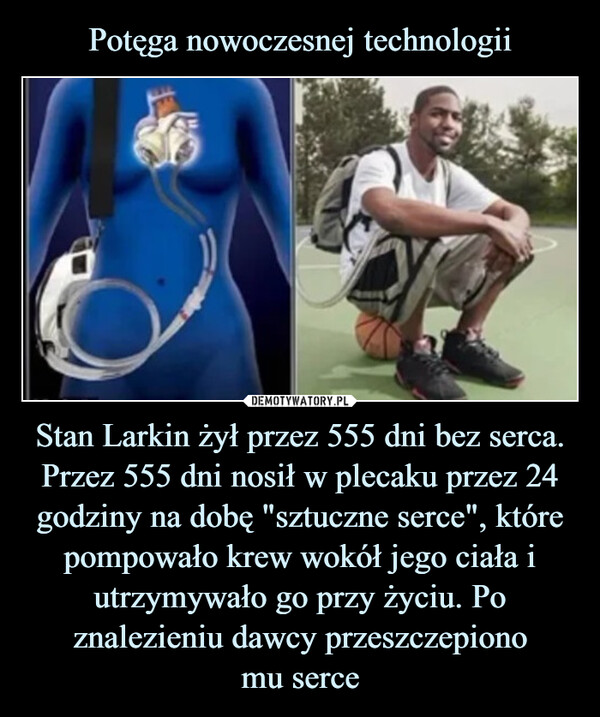 Stan Larkin żył przez 555 dni bez serca. Przez 555 dni nosił w plecaku przez 24 godziny na dobę "sztuczne serce", które pompowało krew wokół jego ciała iutrzymywało go przy życiu. Po znalezieniu dawcy przeszczepionomu serce –  